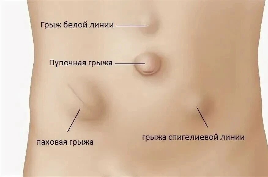 Как понять, что у вас грыжа?