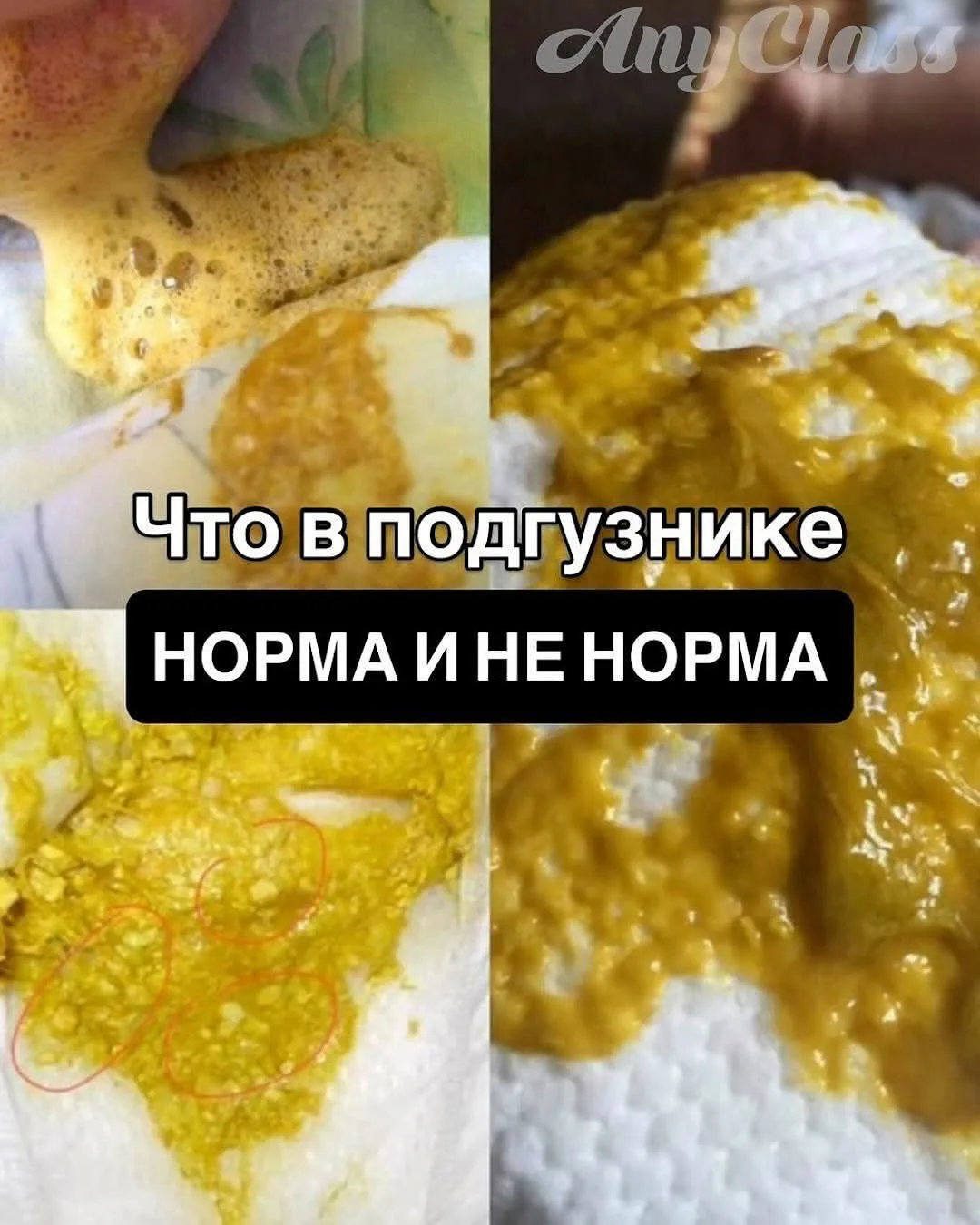 ШПАРГАЛКА ПО ПОДГУЗНИКУ - О ЧЕМ ГОВОРИТ СТУЛ МАЛЫША? 🤫