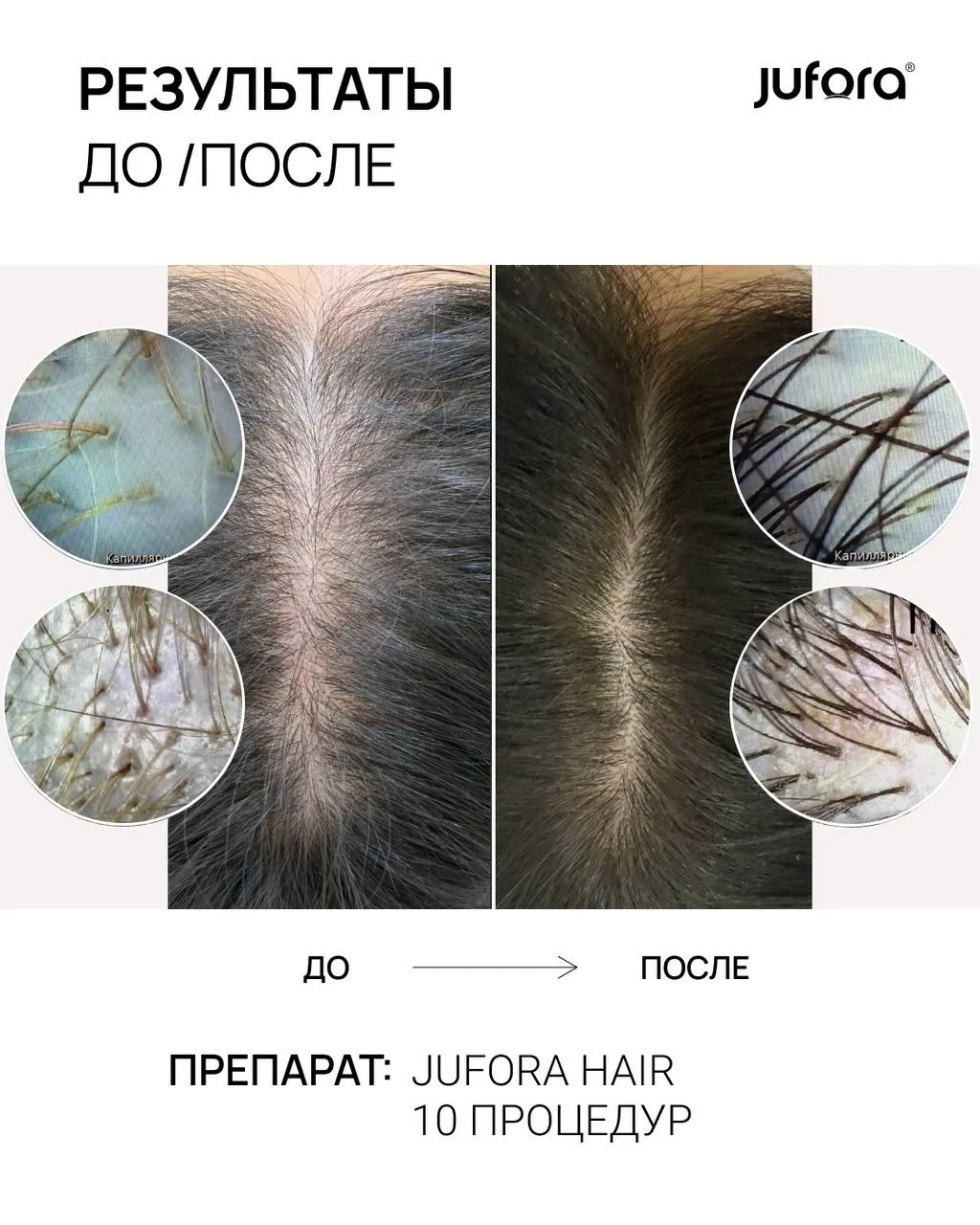Сегодня в кадре: мезотерапия волос препаратом JUFORA® HAIR 💆‍♀️
10 процедур, и результат говорит са