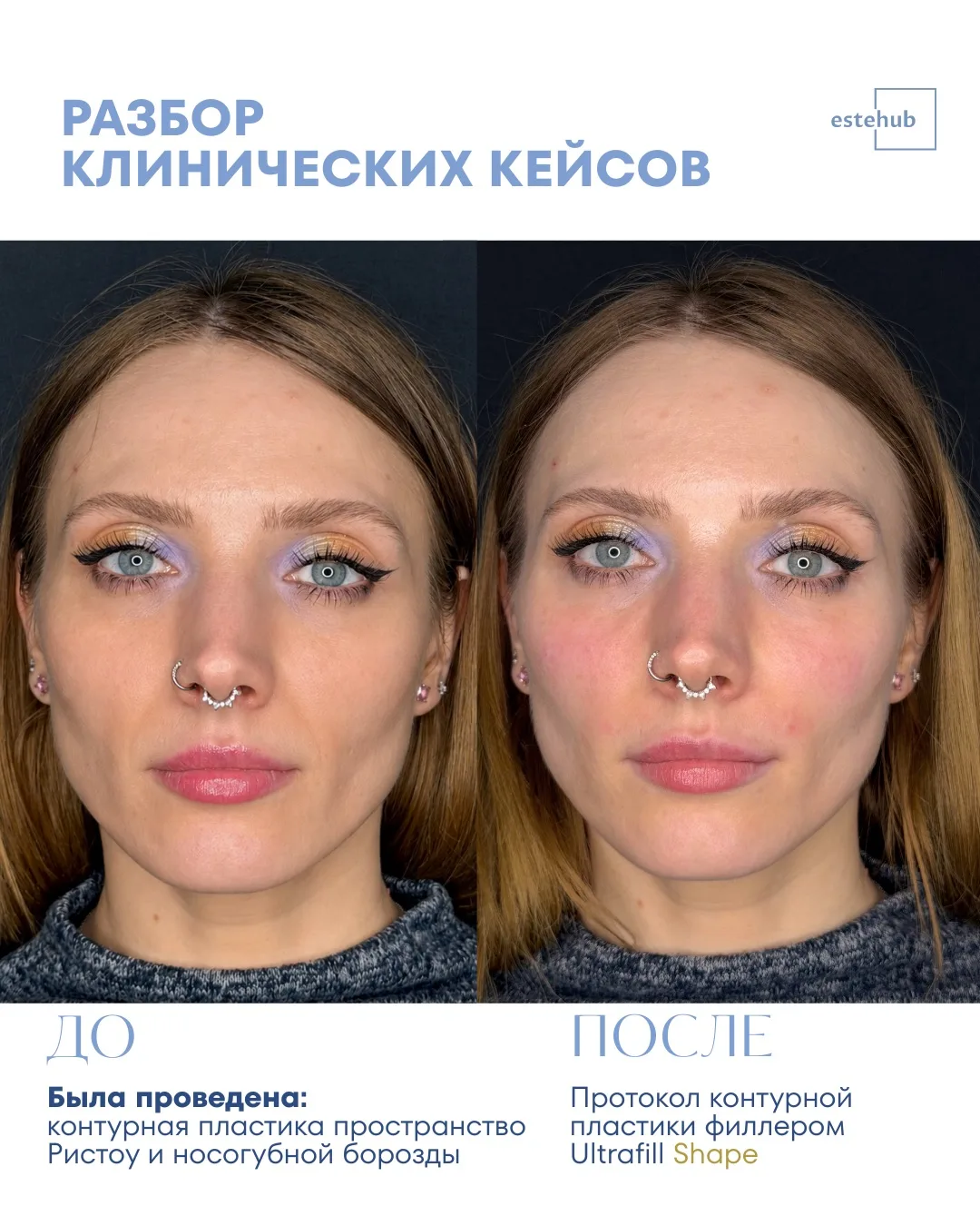 🔍Разбор клинического кейса

Пациента беспокоили выраженные носогубные складки, которые создавали эф