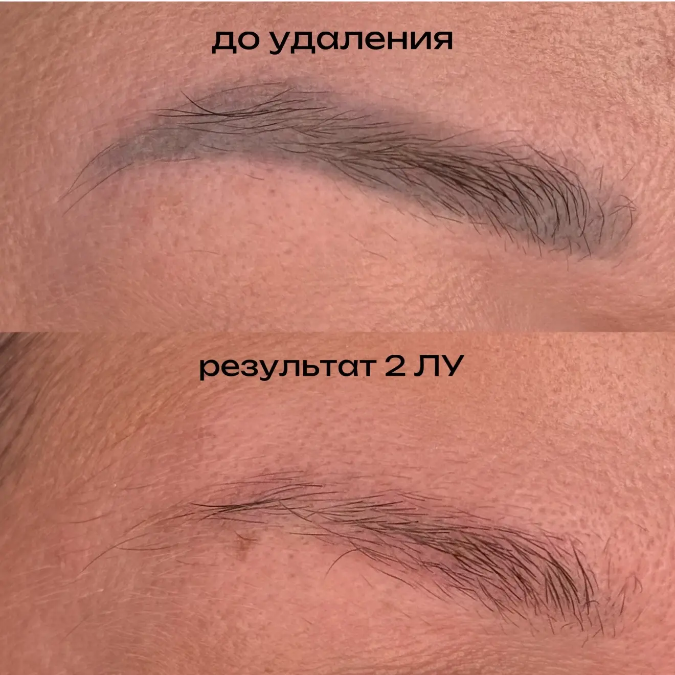 Результат всего лишь 2х лазерных удалений, почти до чистой кожи ✨