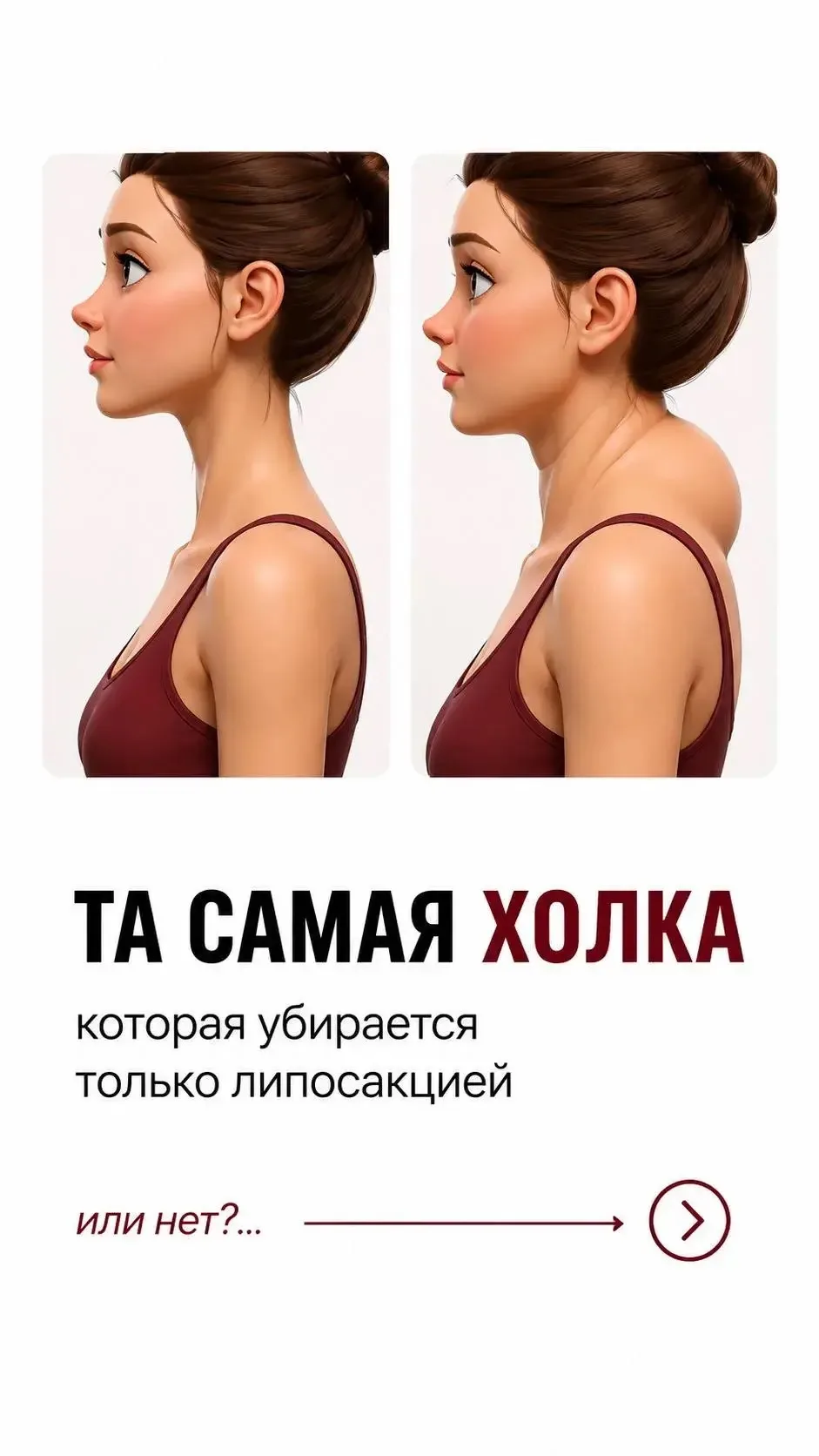 ТА САМАЯ ХОЛКА которая убирается только липосакцией