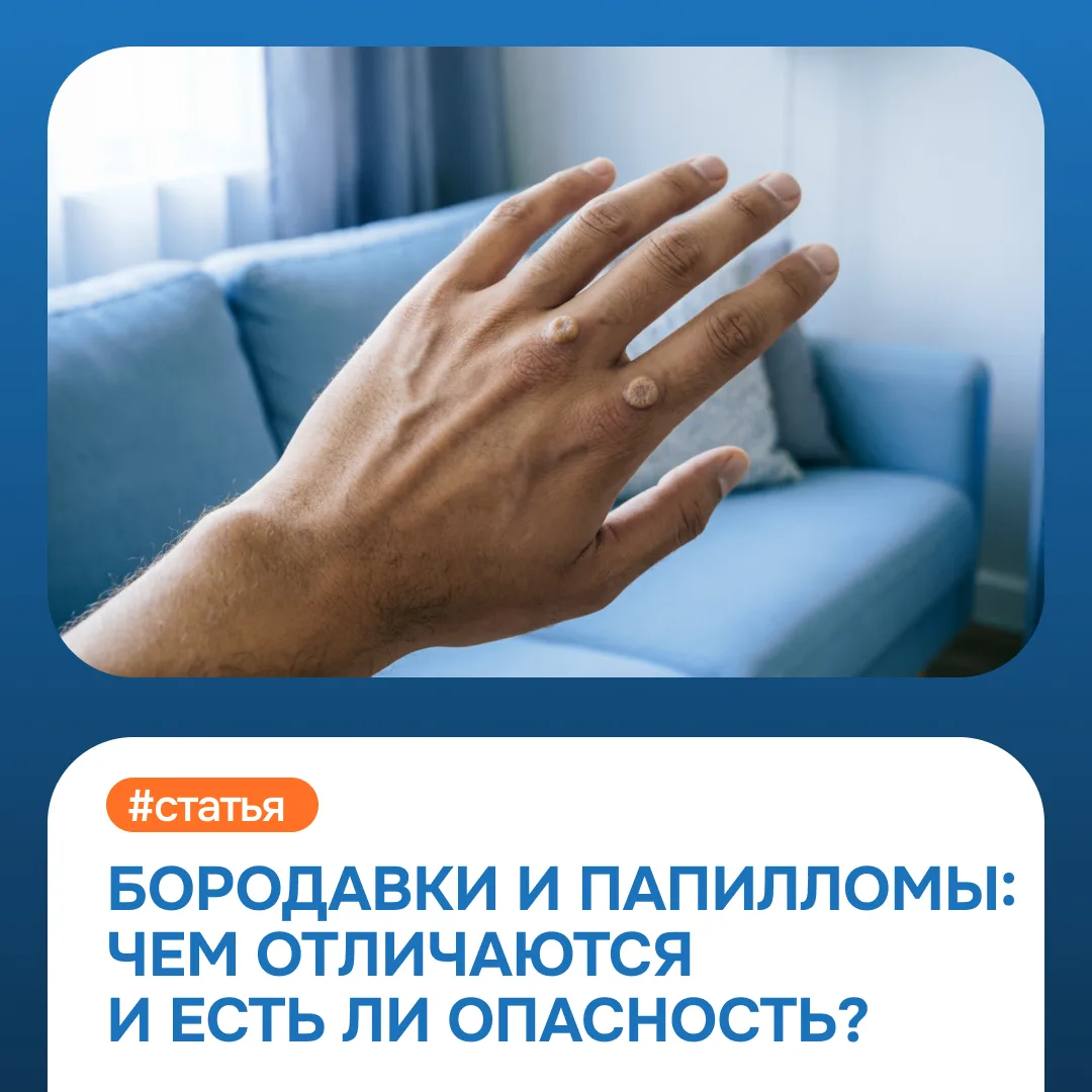 🧬 Бородавки и папилломы появляются на коже часто и пугают многих. Их легко спутать меж...
