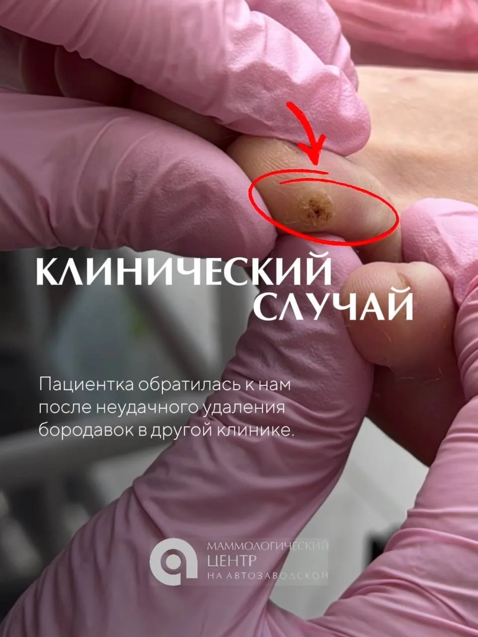 Удаление новообразования кожи выполнил врач Набиуллин Равиль Раилевич - онколог-дермато...