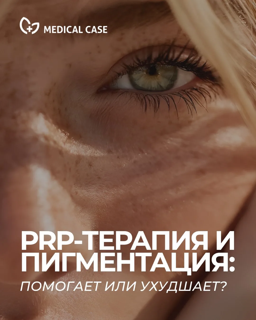 ☀️ PRP и пигментация: помогает или ухудшает?