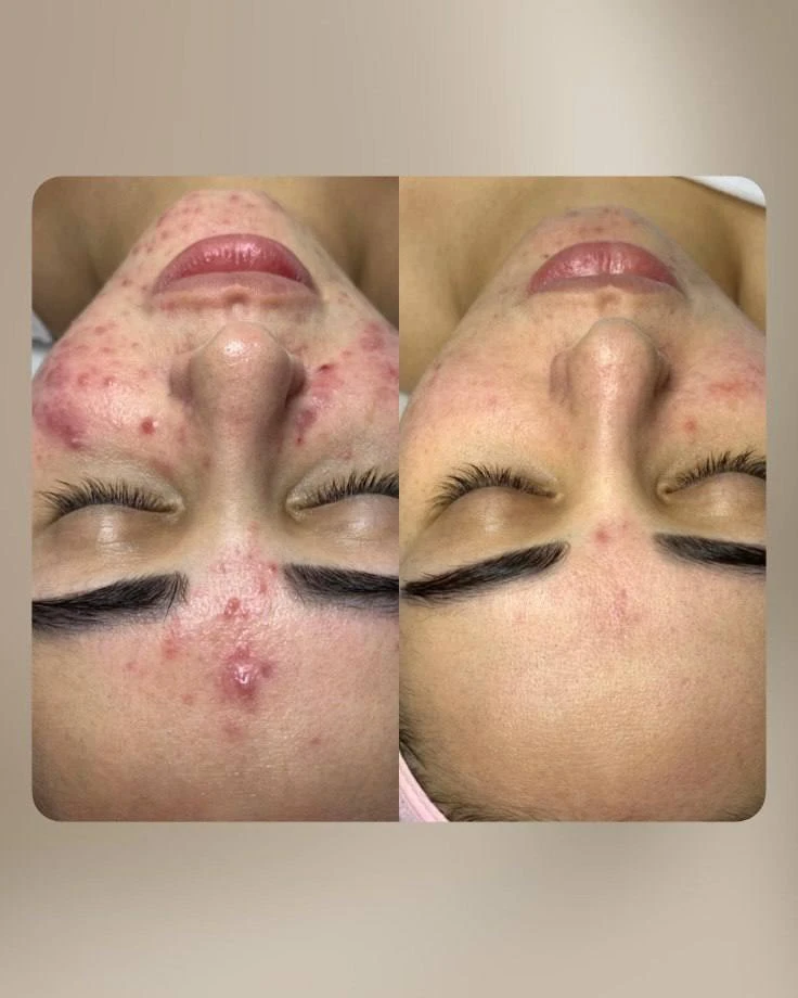 Зелёный пилинг Green Peel - это  комфортная   процедура , которая стимулирует и освежае...