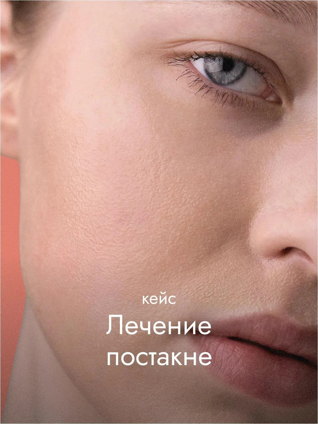 Акне у взрослых встречается часто и поддаётся лечению при правильном подборе методов. У...