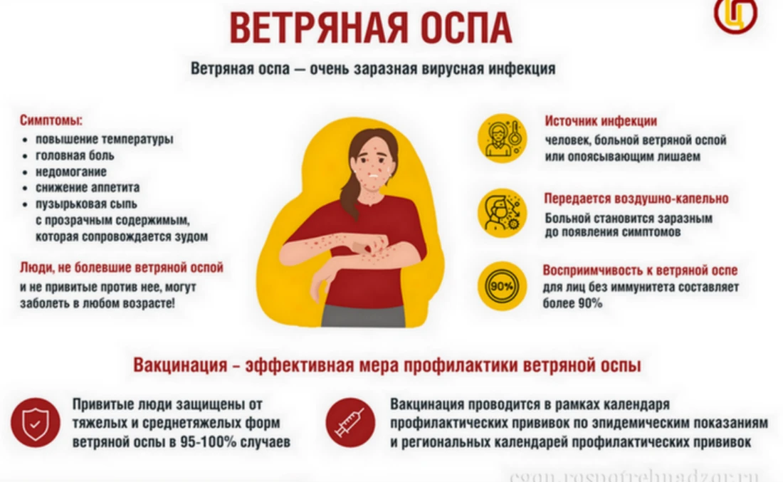‍Ветряная оспа, известная как ветрянка, — очень заразное вирусное заболевание, передающееся воздушно