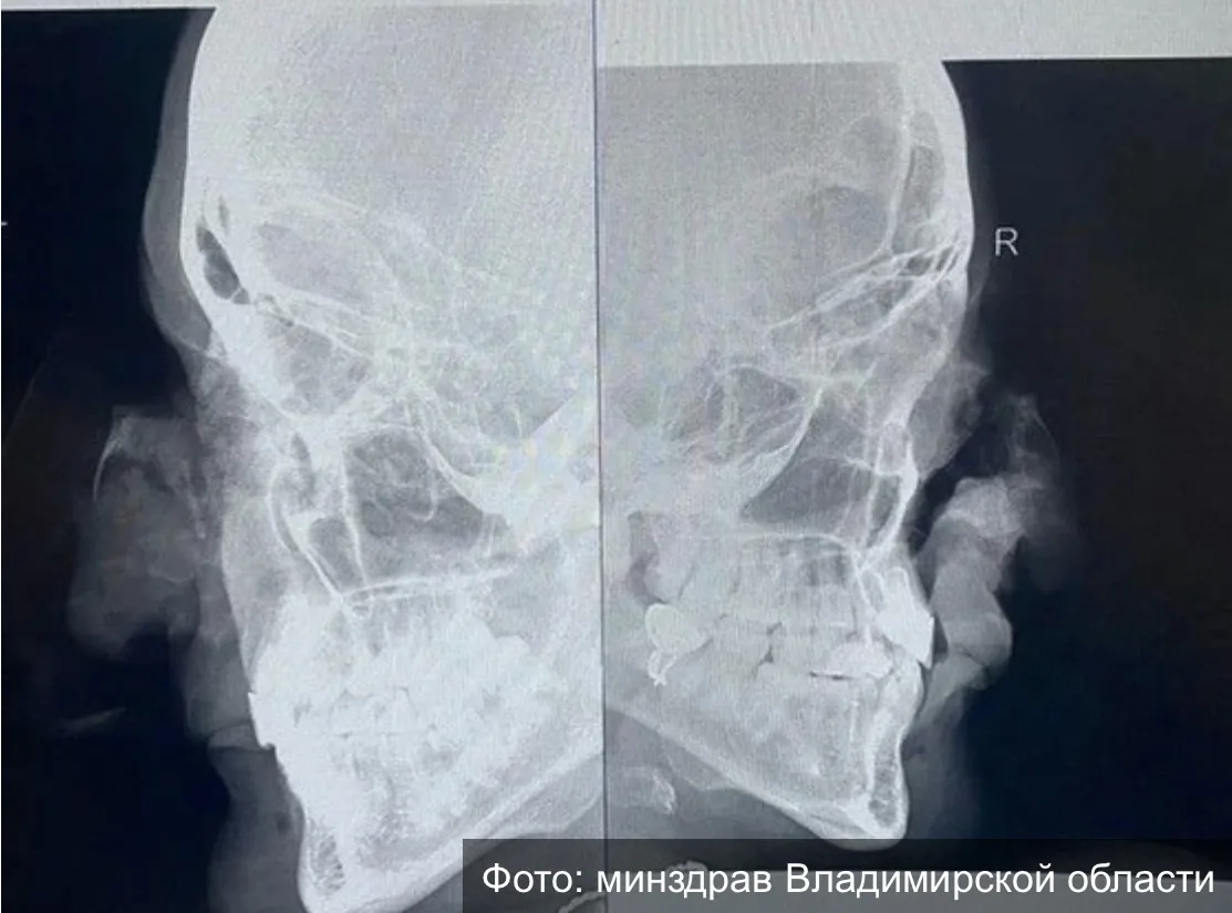 😧👨‍⚕️ Владимирские врачи спасли женщине лицо после трагедии на мосту