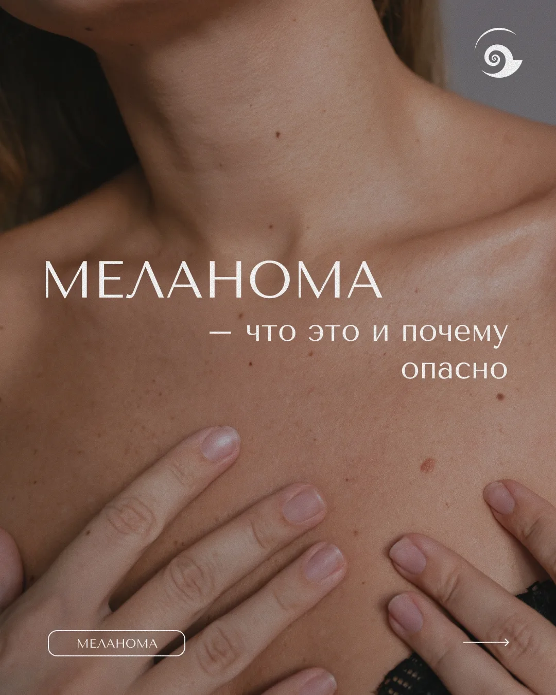 Сегодня — День меланомы. Эта дата создана, чтобы напомнить каждому: ранняя диагностика ...