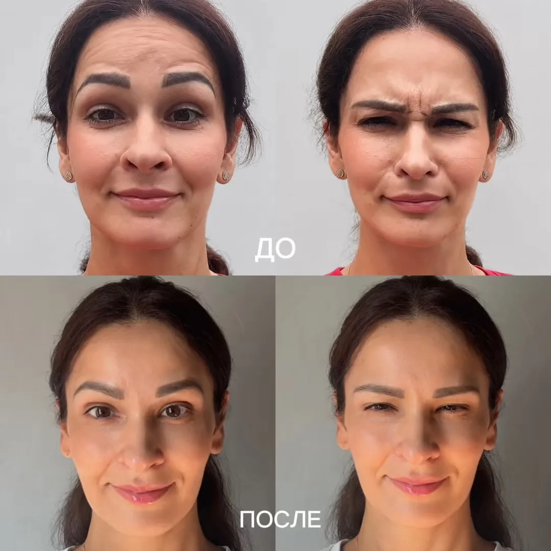 БОТУЛИНОТЕРАПИЯ FULL FACE.