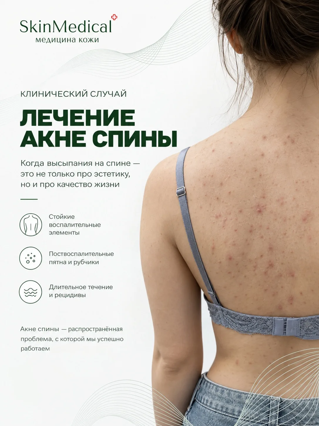 Почему акне на спине нельзя лечить так же, как и на лице?