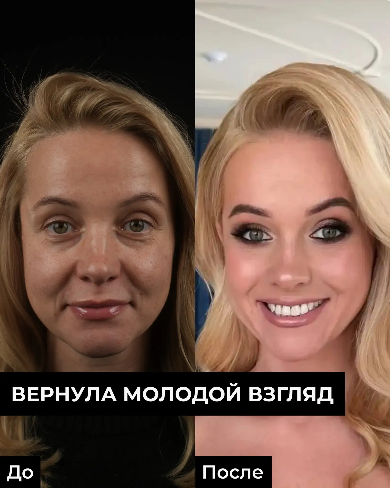 Пациентка Юлия пришла ко мне с запросом избавиться от постоянно усталого и отекшего вида😱