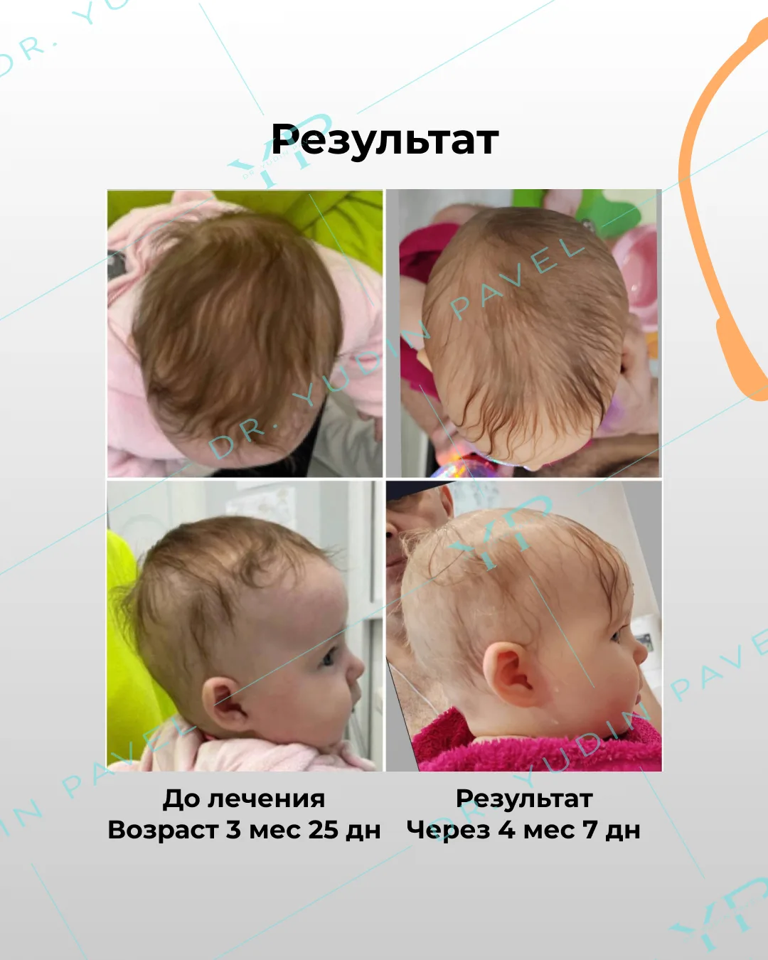 Наша пациентка завершила лечение шлемом ОРТОТИС! 🎉