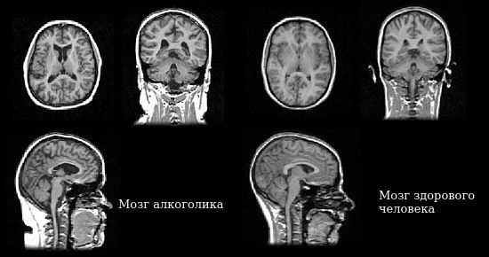 «Безопасных доз нет»

Сотрудники Заиграевской ЦРБ поделились историей, где алкоголь лишил будущего в