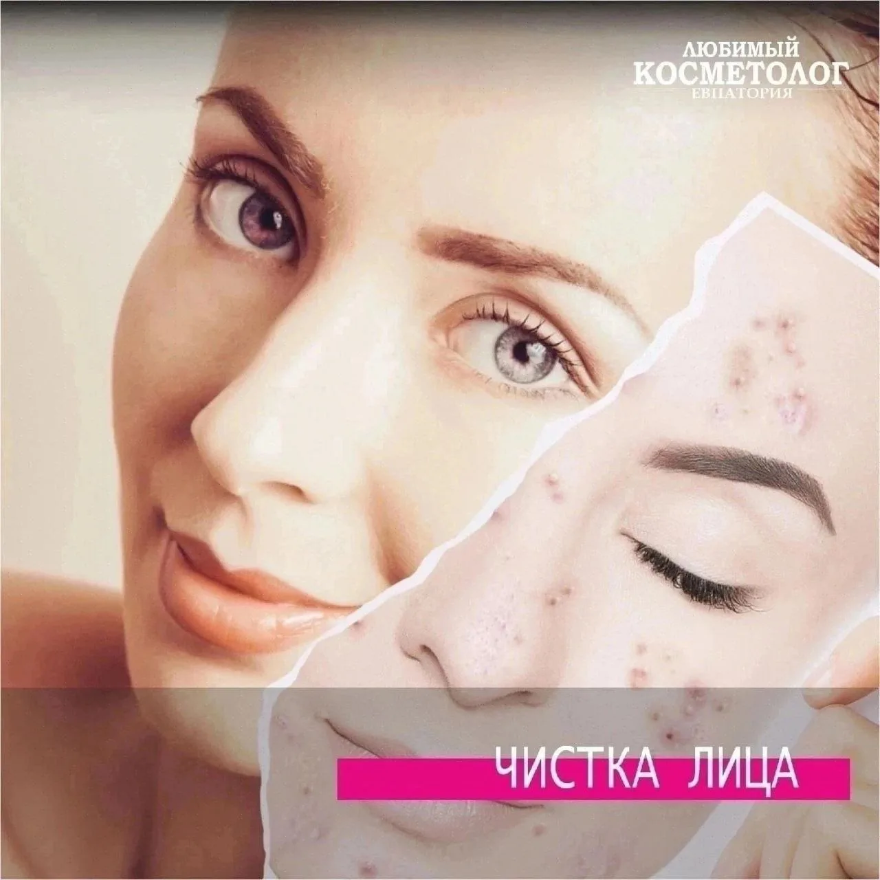 💥 Одна из самых востребованных процедур на сегодняшний день.💥