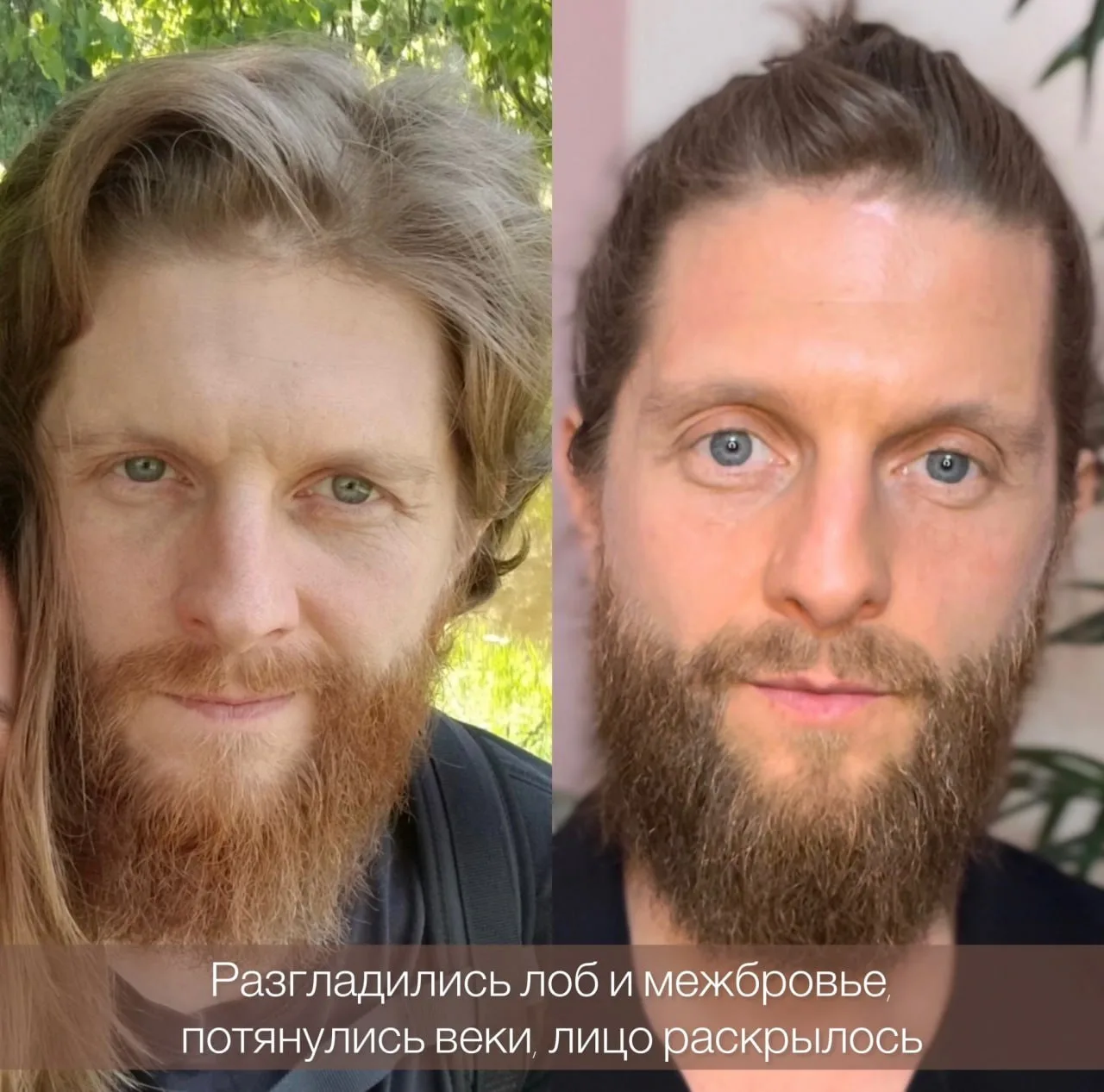 💬 "Да это свет… фильтры… уколы…  Девчонки, мне это пишут под каждым до-после.  И особенно — под резу