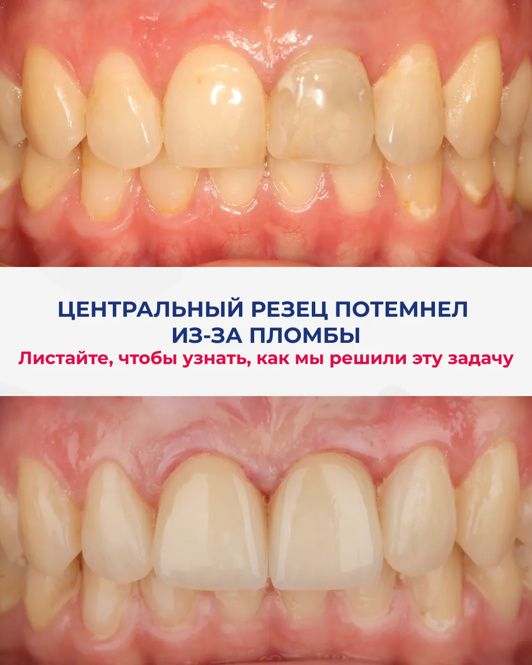 У пациентки центральный резец был восстановлен большой несостоятельной пломбой.