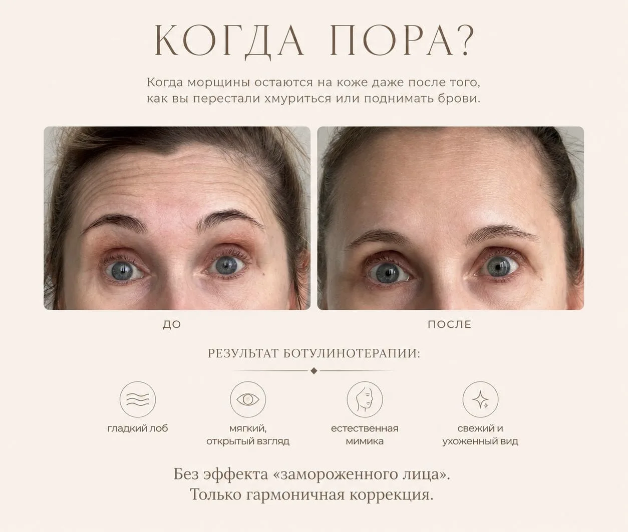 Ботулинотерапия 🫶🏻