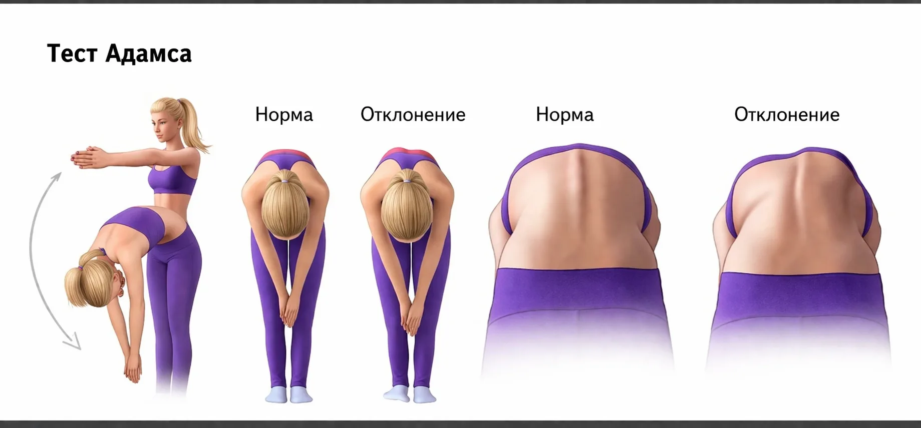 Привет друзья!
Сегодня обсуждаем моменты связанные с первичной диагностикой сколиоза и скрытый струк