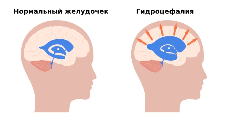 Гидроцефалия - заболевание, сопровождающееся увеличением в размерах желудочков головног...