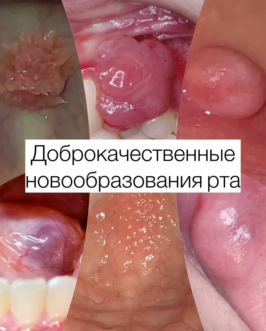 Доброкачественные новообразования полости рта