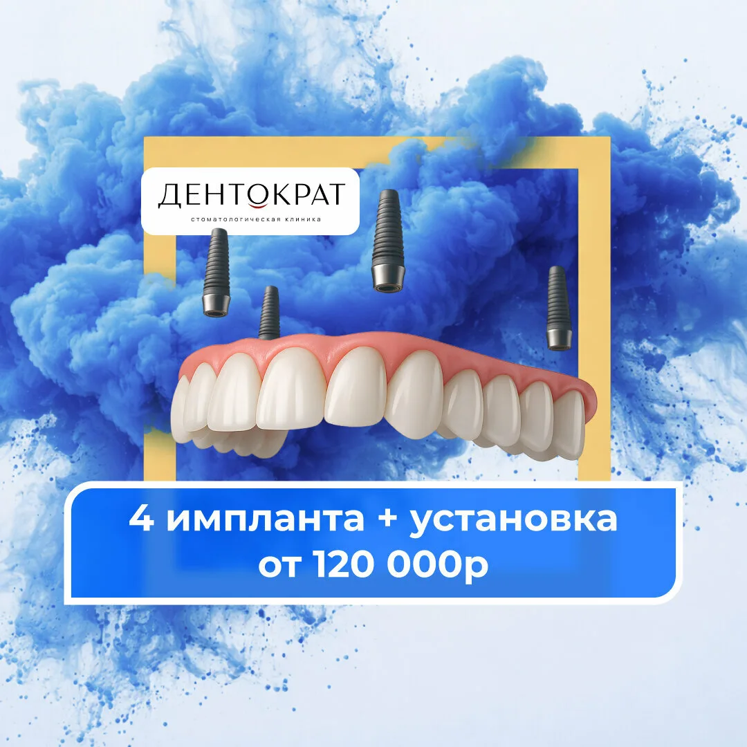 Все зубы на 4 имплантах в Чебоксарах