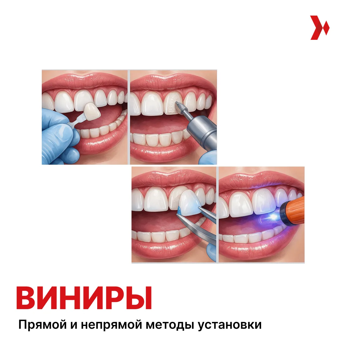 🦷 Прямой и непрямой методы установки виниров: в чём разница?