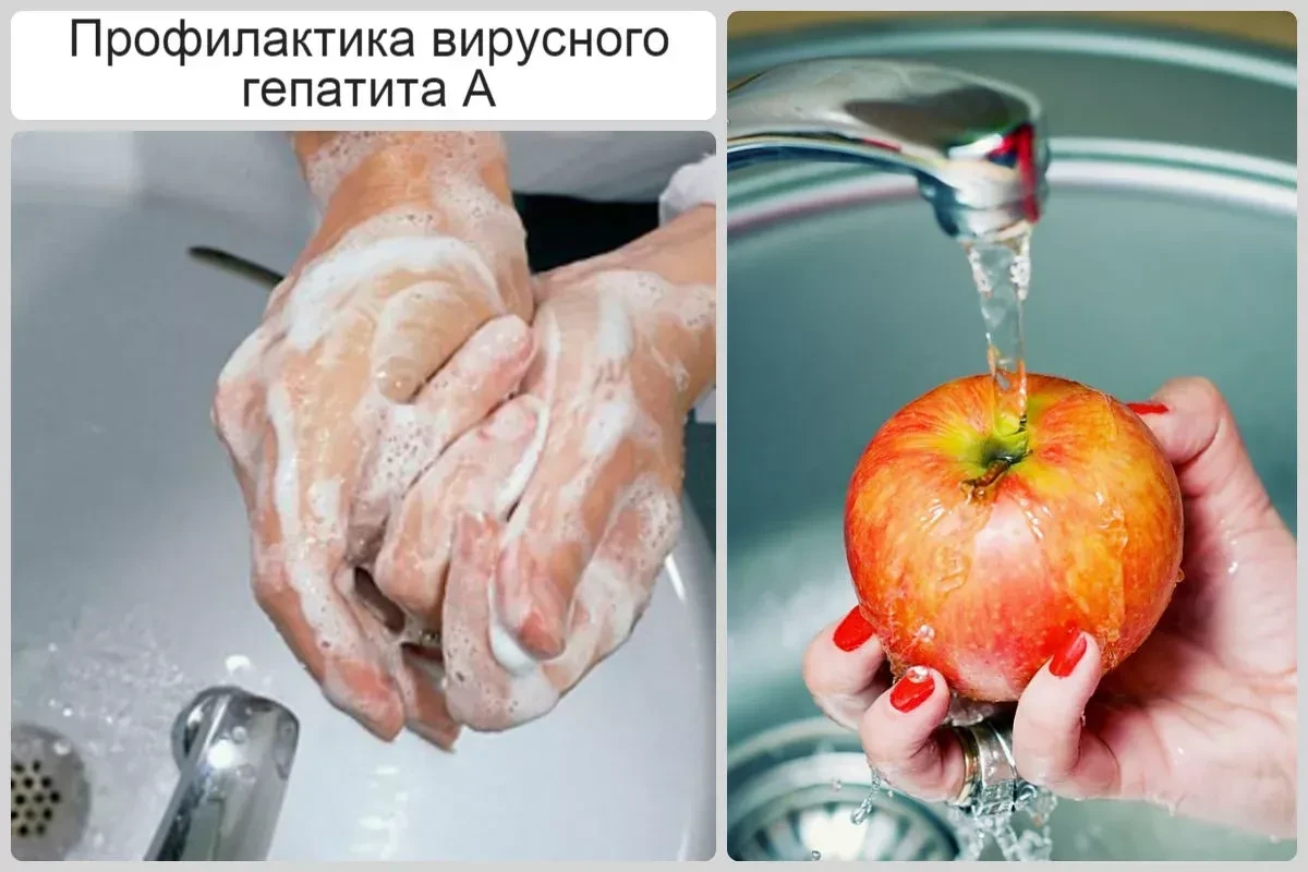 Гепатит А (или болезнь Боткина) — это острое вирусное заболевание печени, которое перед...