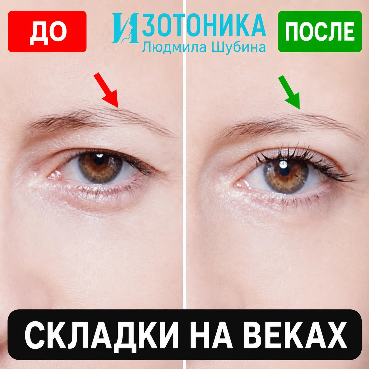 Корейские дерматологи измерили могут ли складки на веках подтягиваться