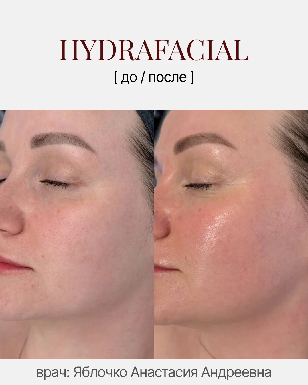 До» и «после» после HydraFacial: кожа как после отпуска — свежая, увлажнённая, без туск...