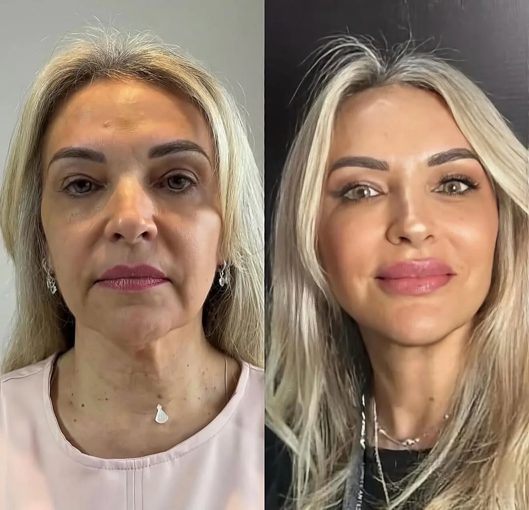 Девочки,здесь проведены 2 процедуры ❤️