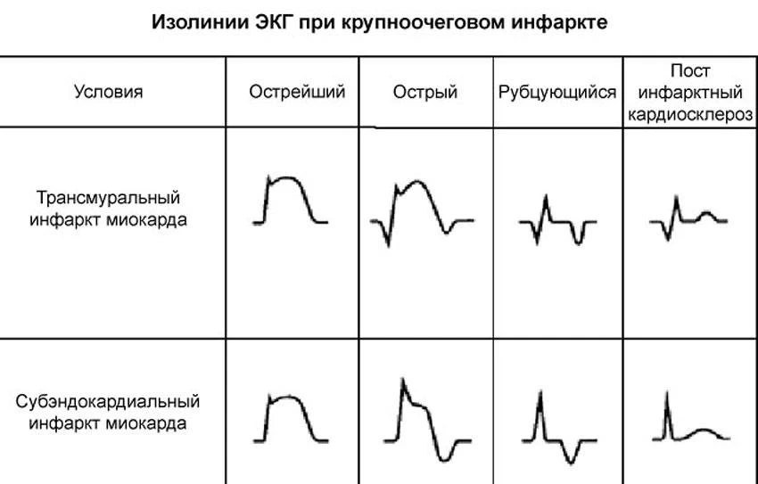 Какая истинная картина инфаркта миокарда?