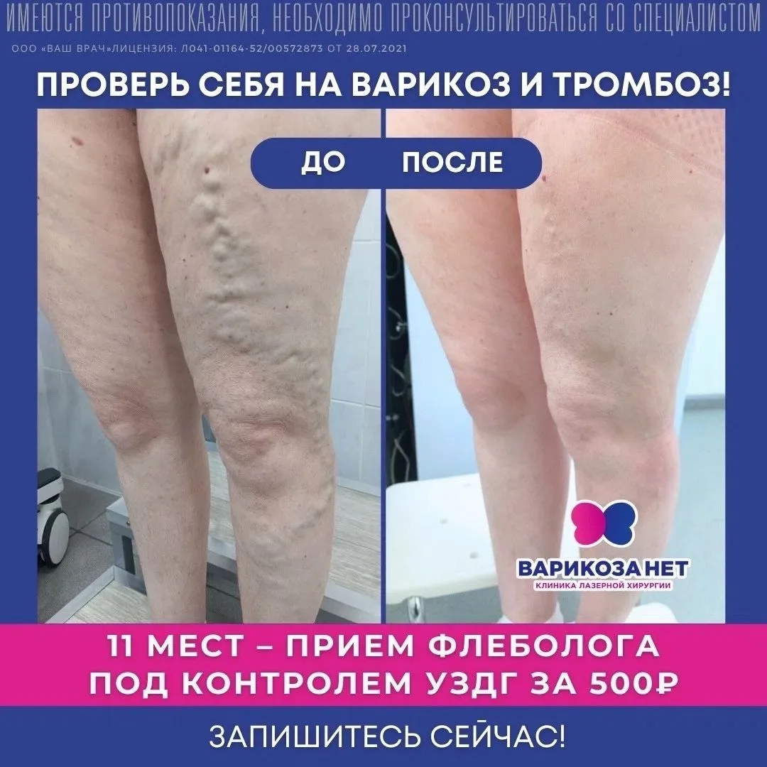 Варикоз — не косметика. Это риск тромбов. ⛔️