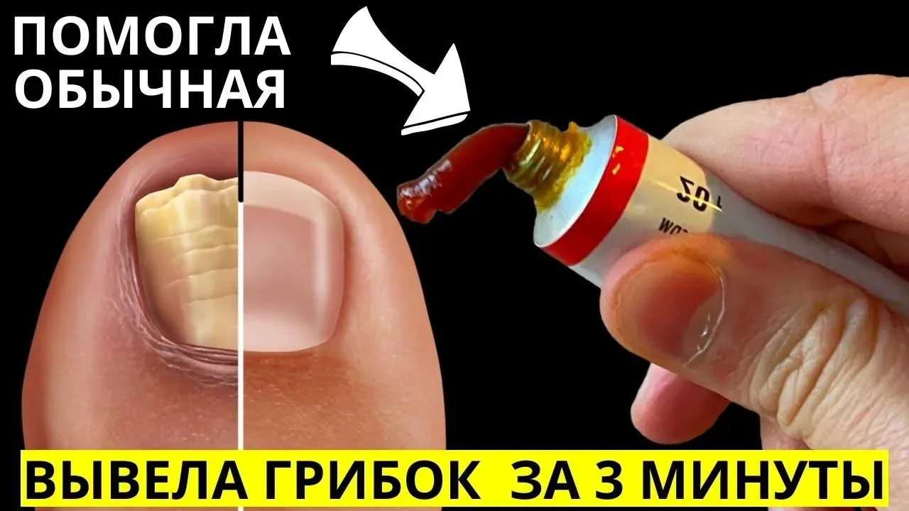 Грибок отсохнет за одну ночь!  Эта ядрёная советская мазь разъест весь грибок с ногтей навсегда! Я н
