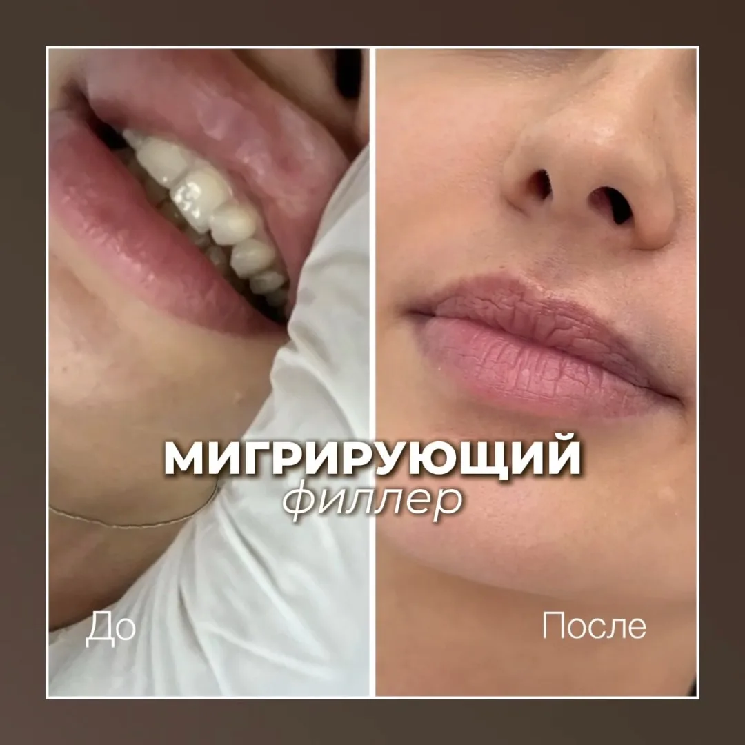 Удалили мигрирующий филлер всего за 1 процедуру! 👄