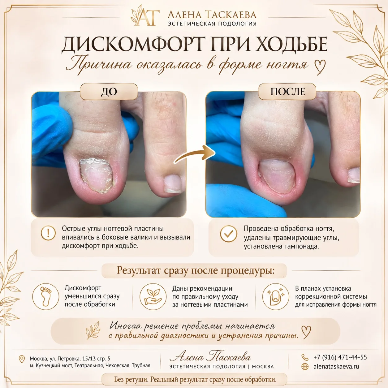 Когда причина дискомфорта — не в ногте, а в том, как он подстрижен 👣