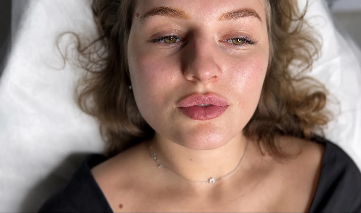 Контурная пластика губ, результат промежуточный, через 14 дней👄