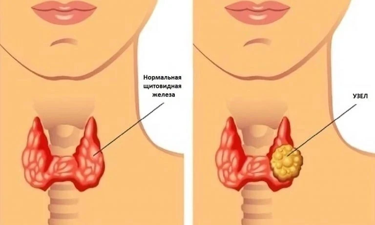 УЗEЛ НА ЩИTOВИДКЕ УЙДЕТ ЧEPЕЗ 6 HEДЕЛЬ✅