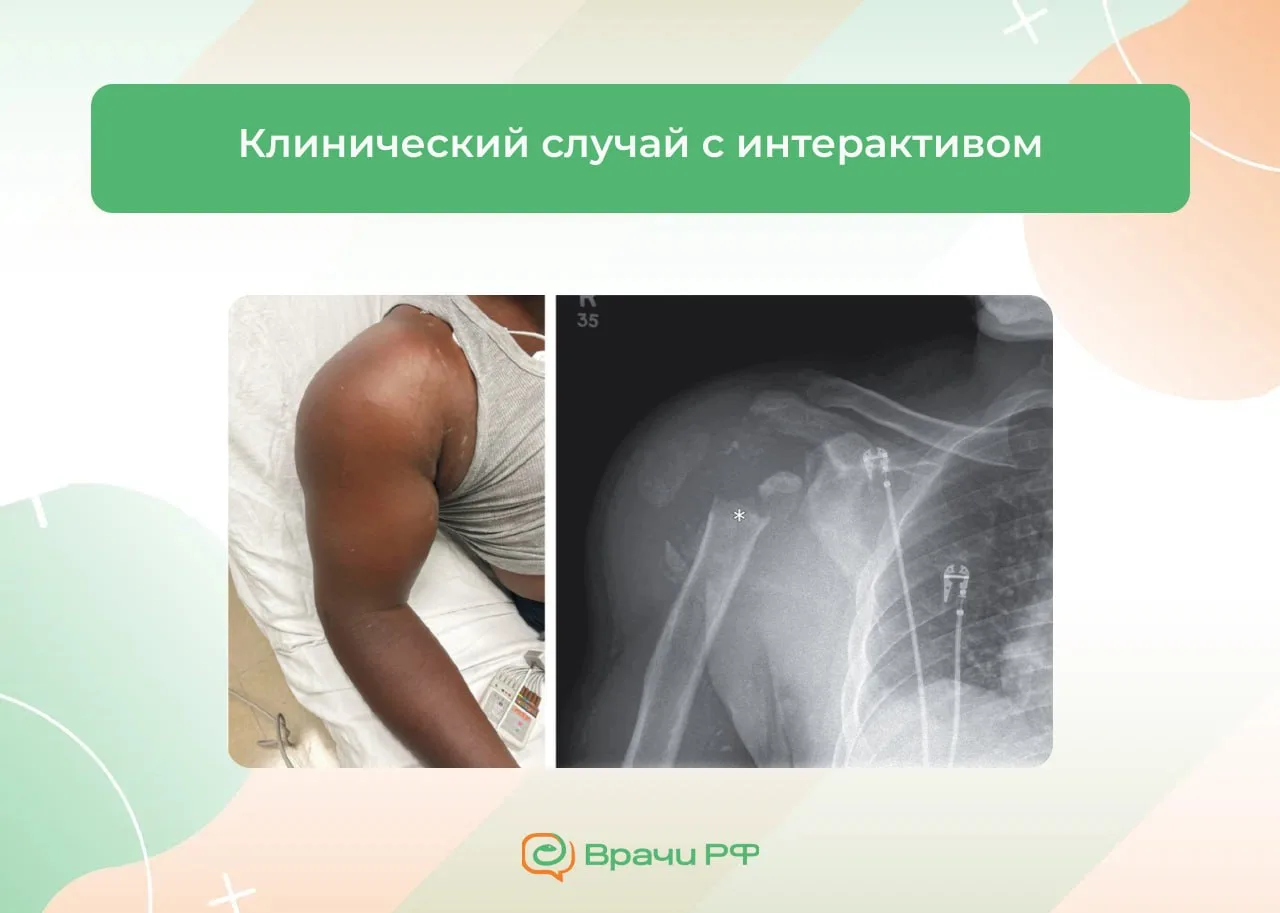 🧠 Мужчина с болью и отечностью правого плечевого сустава. Клинический случай с интерактивом

Мужчин