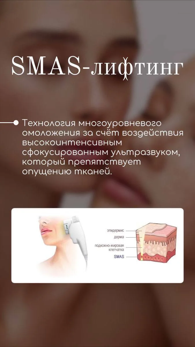 SMAS-лифтинг — это безоперационная аппаратная подтяжка лица  с помощью сфокусированного...