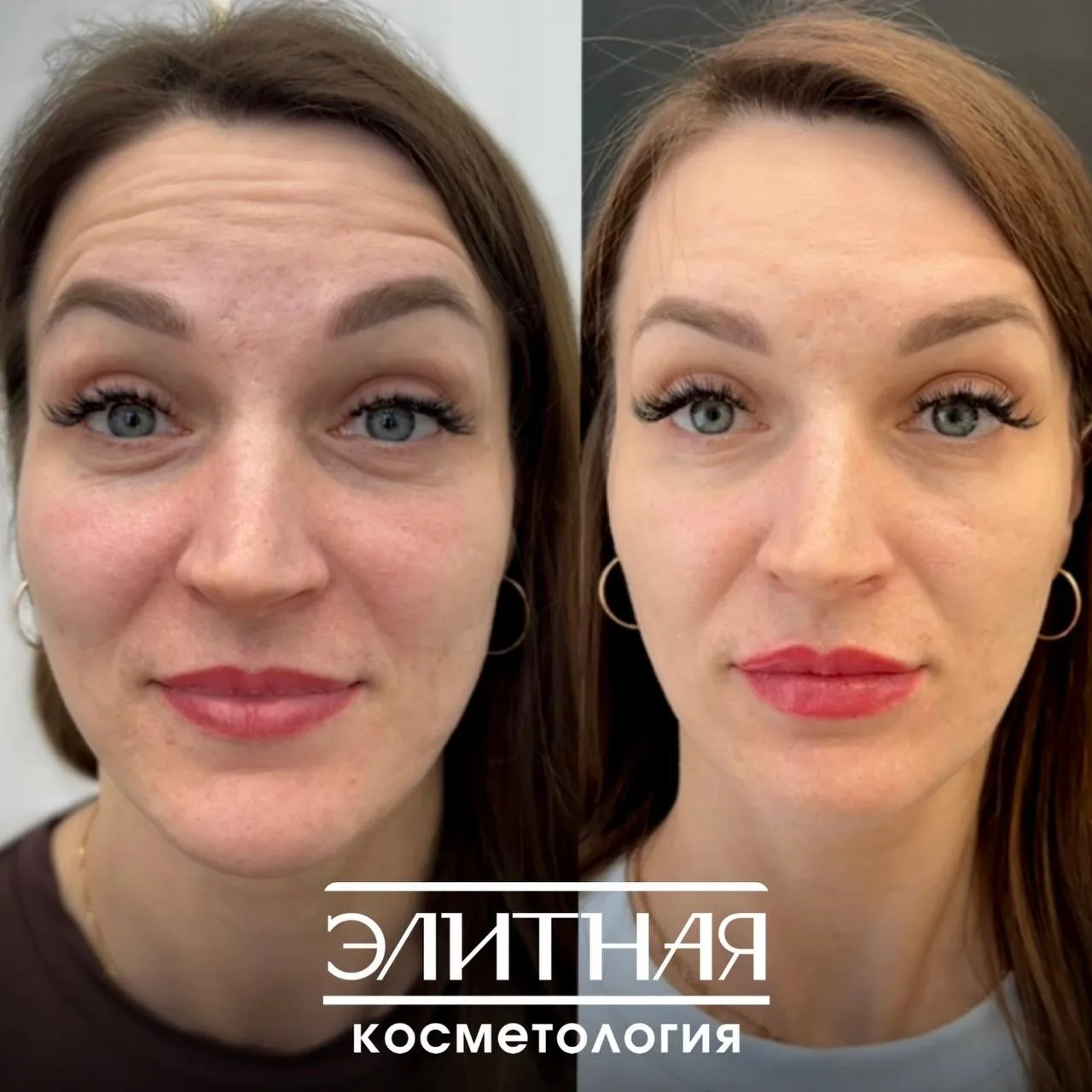 ПОДТЯНУТОЕ И СВЕЖЕЕ ЛИЦО всего ЗА 1 ПРОЦЕДУРУ 🔥