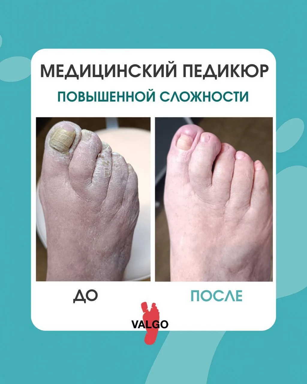 Медицинский гигиенический педикюр повышенной сложности 👣

Грибковое поражение кожи и ногтей — это н