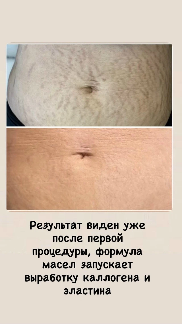 Девушки ИРКУТСКА! Открыта запись 25-26 июня на процедуру Микронидлинга (удаление растяж...