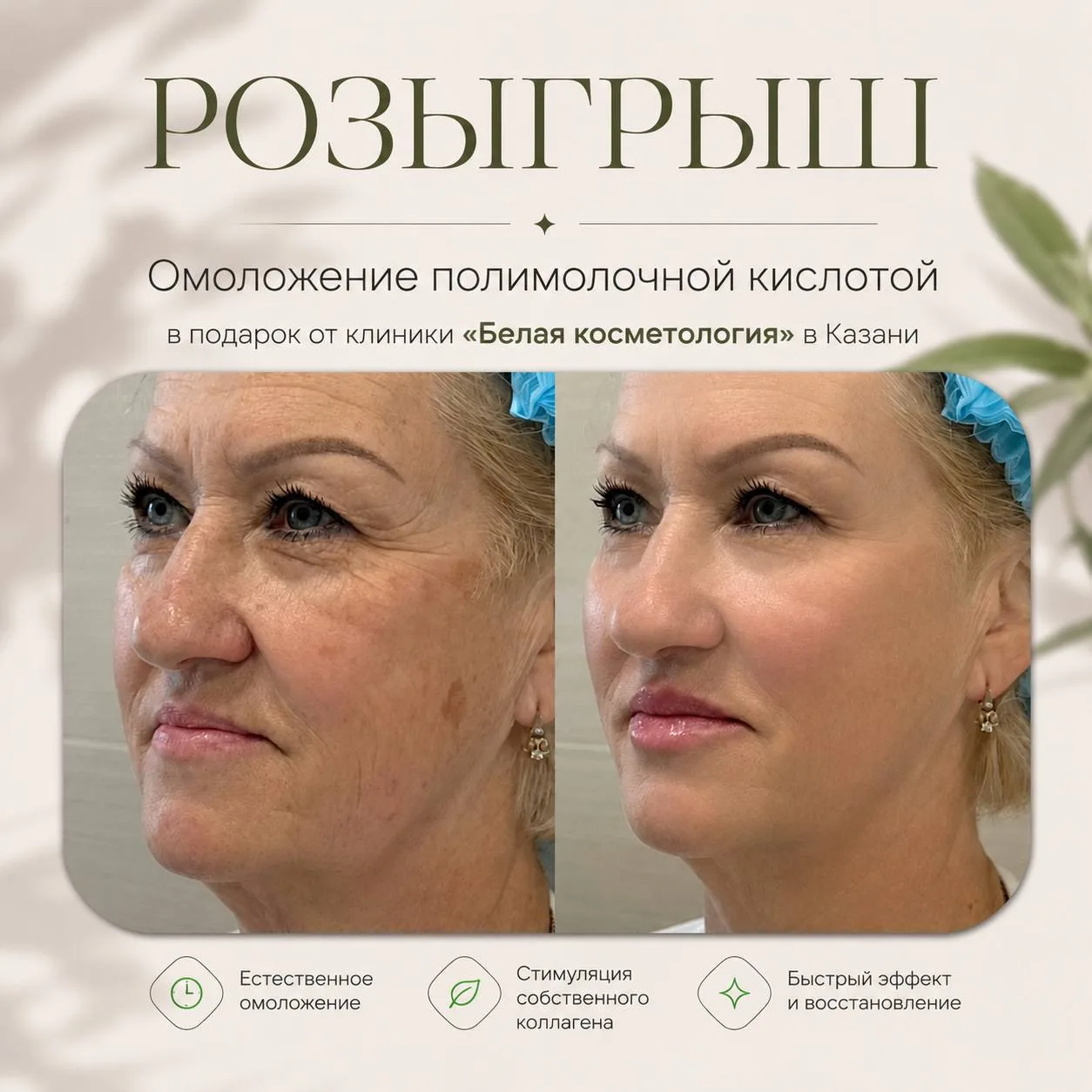Дарим омоложение полимолочной кислотой, одной из наших подписчиц💋