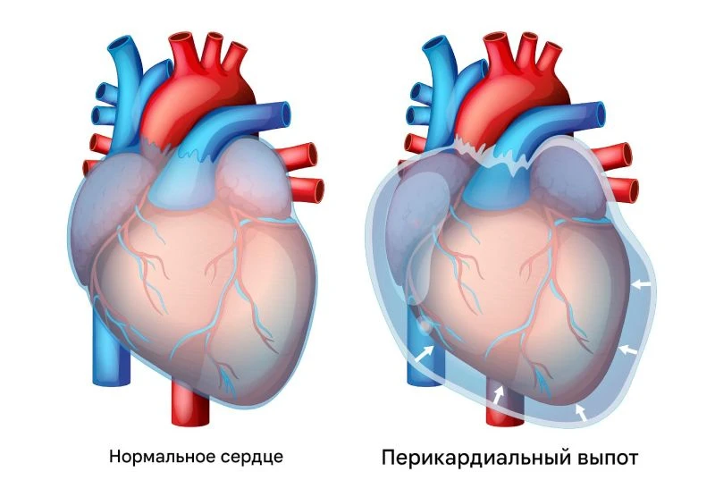 💔 Боль в груди? Это может быть не инфаркт