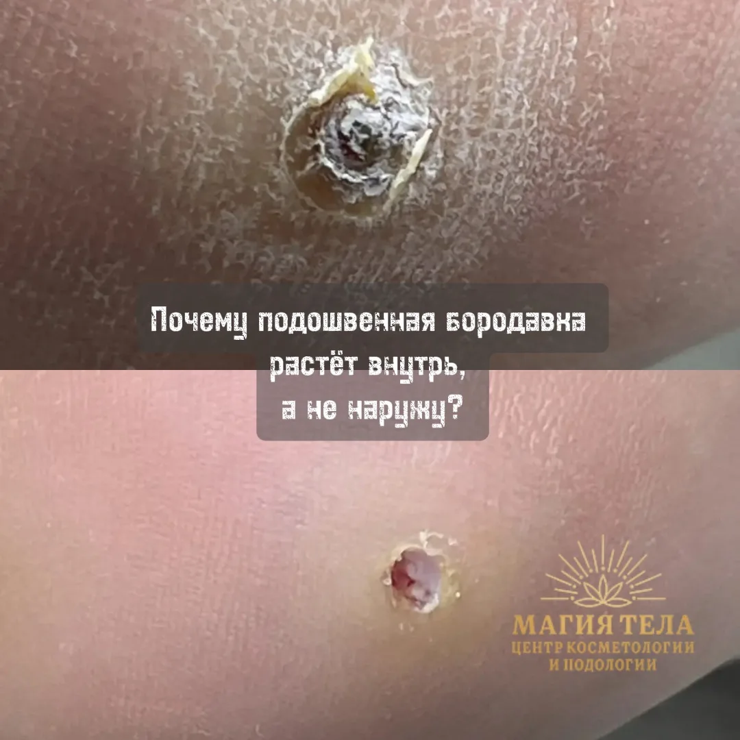 🦠 Почему подошвенная бородавка растёт внутрь, а не наружу?