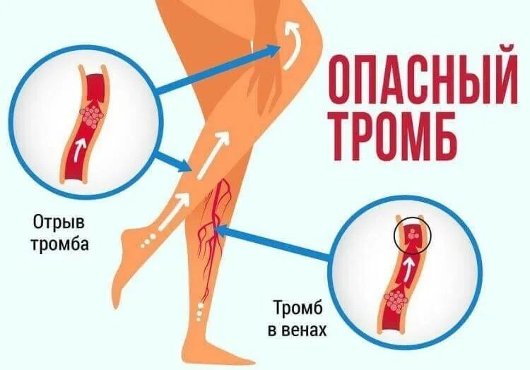 Чтo cдeлaть чтoбы тpoмбы нe вoзникли? Πpoфилaктикa.