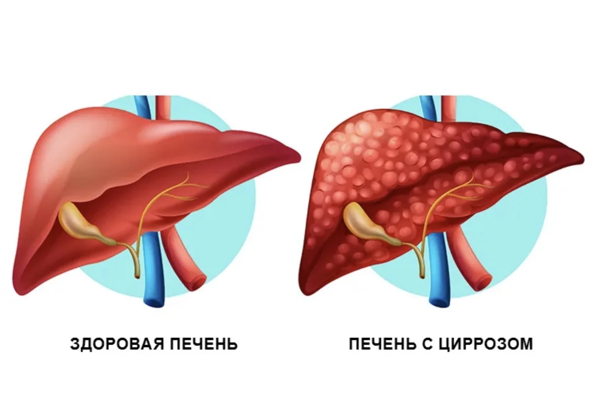 Цирроз печени – не приговор!