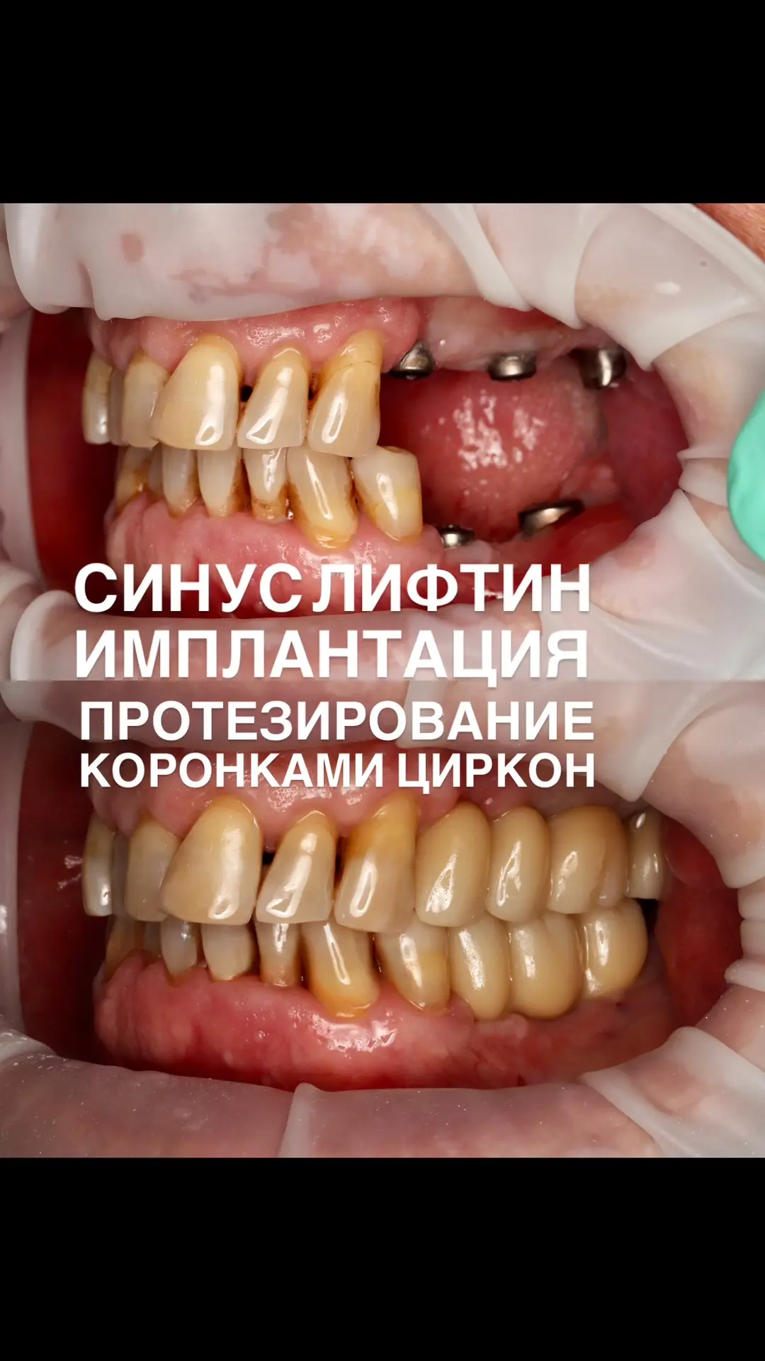 Протезирование имплантов на верхней и нижней челюсти в @doctor_potanova